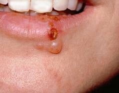 Conceito de herpes Conceito de herpes