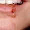 Conceito de herpes